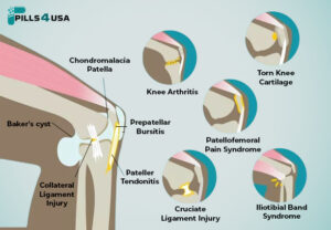 knee arthritis